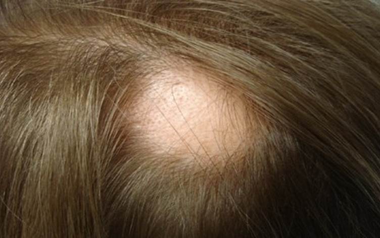 Витамины для себорее волосистой части головы