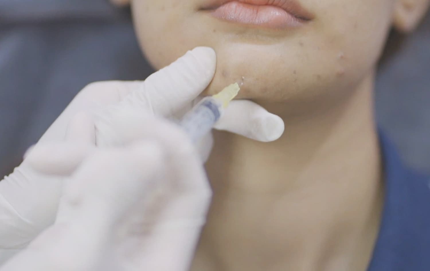 پسپۆڕێک: قوربانییانی ژەهراویبوون بە بۆتۆکس زیاد بوون و ئاگاداربن