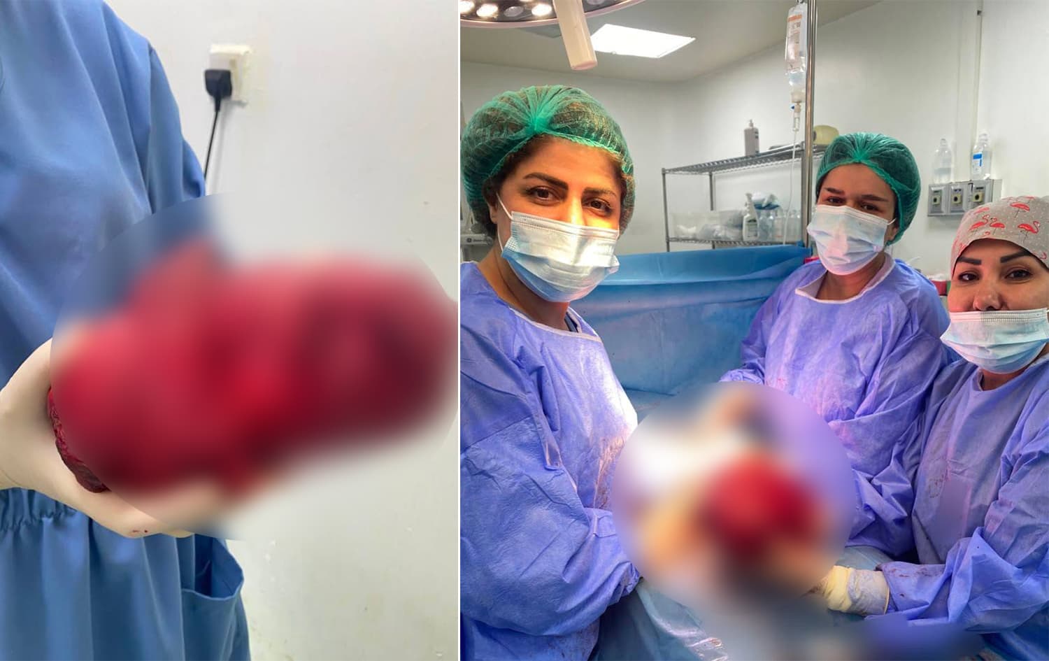 ئەو پزیشکەی گرێیەکی 20 سانتیمەتری دەرهێنا: نەمانهێشت نەخۆشەکە نەزۆک بێت