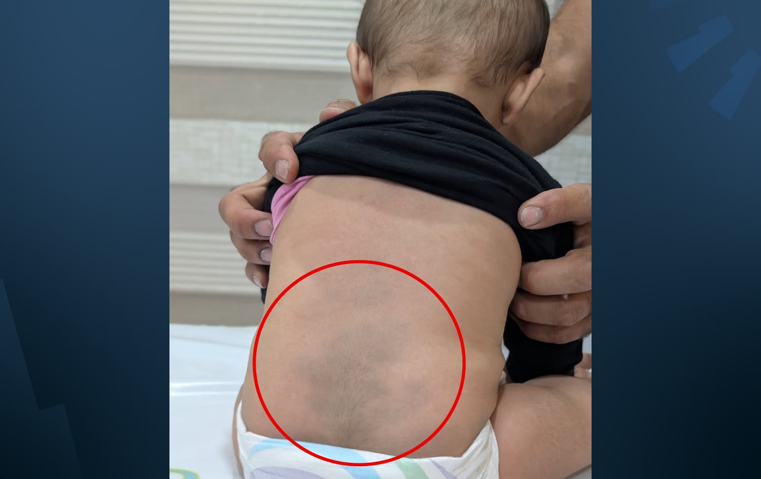 پزیشکێکی منداڵان هەڵەتێگەیشتنێک لەبارەی ئەم پەڵەیەی منداڵان راست دەکاتەوە