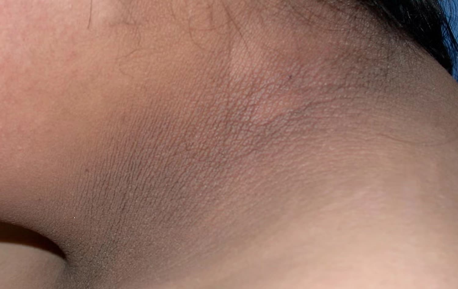 پسۆڕێک: قەڵەوبوون و رەشبوونی پێست رەنگە نیشانەی شەکرە بن