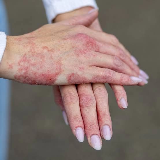 پسپۆڕێک: لە پاییزدا ئەکزیما زیاد دەکات و رێگەکانی چارەسەرکردنی بزانە
