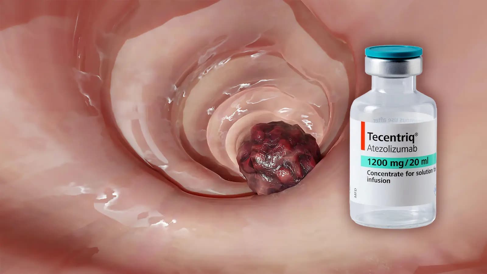 FDA رەزامەندیدا لەسەر دەرمانێک کە رێگری لە گەڕانەوەی شێرپەنجەی کۆڵۆن دەکات