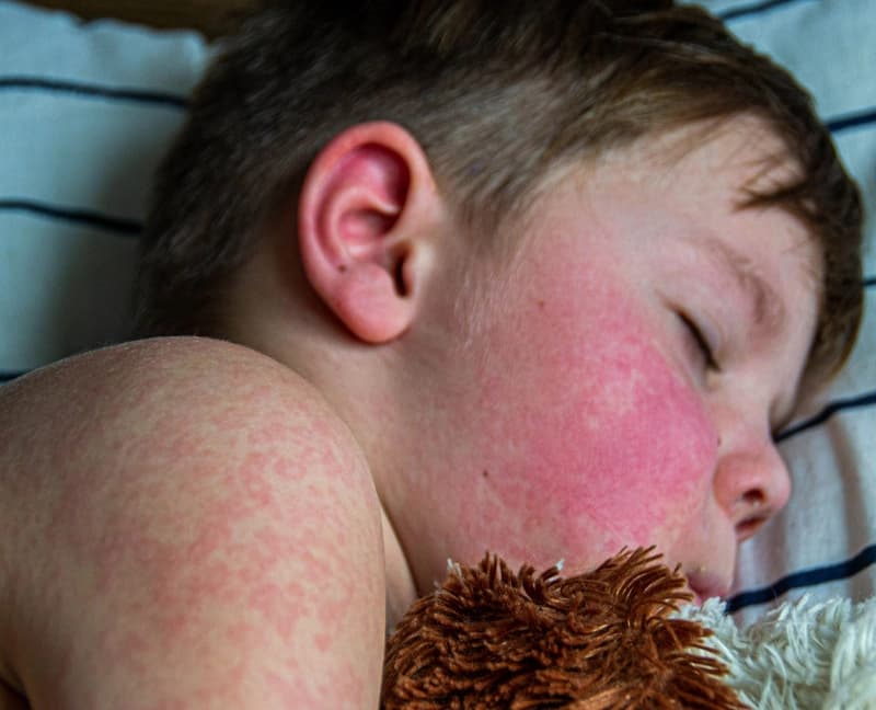 CDC: لە ئەمریکا ژمارەی تووشبووان بە نەخۆشیی سوورێژە لەزیادبوونە