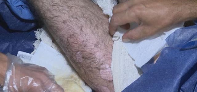 Wounds suffered by a Peshmerga in a suspected Tuesday chemical weapons attack. Rudaw Photo. 