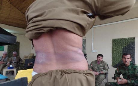 A Peshmerga fighter displays the effects of chemical weapons at an aid event in Makhmour on Tuesday. Photo: Kurt Nagl (Rudaw).  