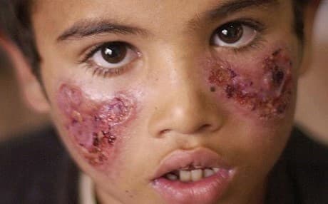 Leishmaniasis wounds.