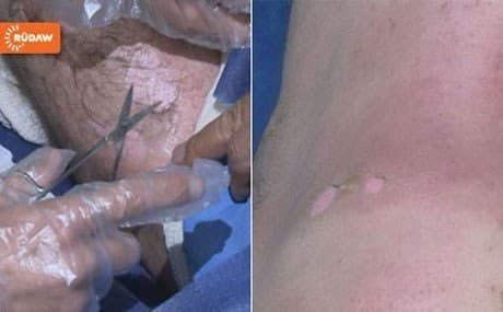 ISIS used chlorine gas against Peshmerga in several cases. 