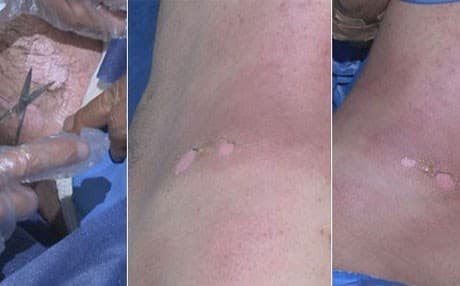 ISIS has used chemical weapons against the Peshmerga several times. Photo: Rudaw archives