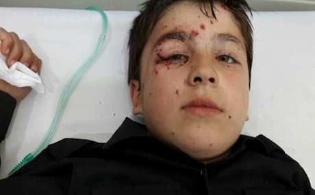 One of the Kurdish boys injured in Friday's mine explosion. Photo: iranwire.com