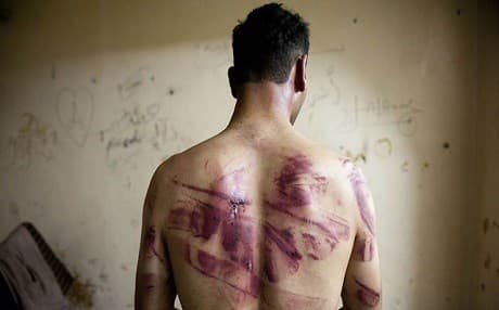Former Syrian detainee showing wounds left by torture. AFP file photo.