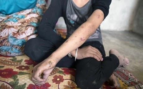 A 10 year old girl from Manbij shows injuries she received when a mine exploded as she and her family were fleeing Manbij in August. Photo: Ole Solvang/Human Rights Watch
