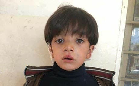 A first-grade student from the town of Khabat underwent surgery on his ears in Erbil after his teacher beat him. Photo: Rudaw