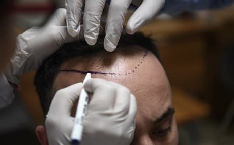 A hair transplant specialist consults with a patient in Istanbul. Photo: Ozan Kose/AFP