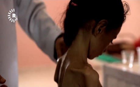 Li Yemenê ji ber şer be an jî birçîbûnê, 5 hezar zarokan canê xwe ji dest dane