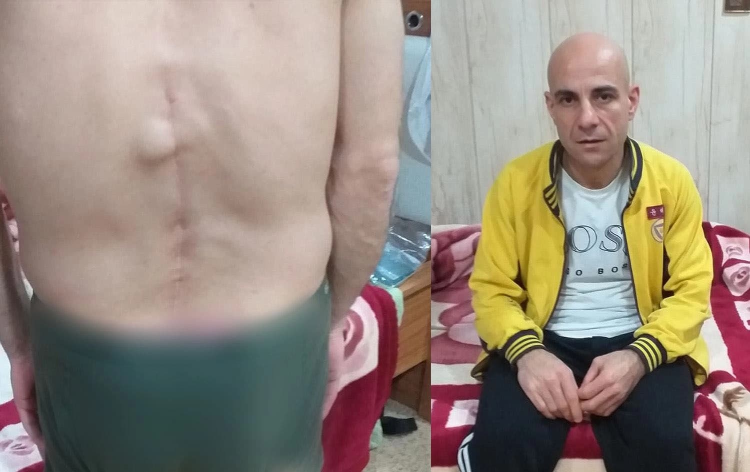The image on the right is Mariwan Mahmood Awla in his family home in Darbandikhan, and the image on the left shows the scars of surgeries on his spine following the fall that led to his disability. Photo: Submitted