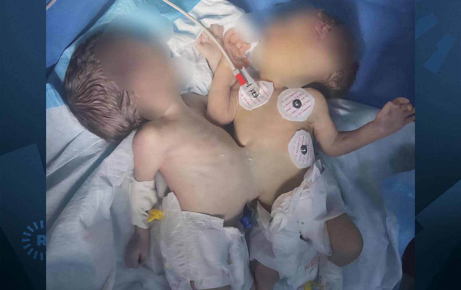 ئەو دوو منداڵەی نەشتەرگەرییەکەیان بۆ کراوە.