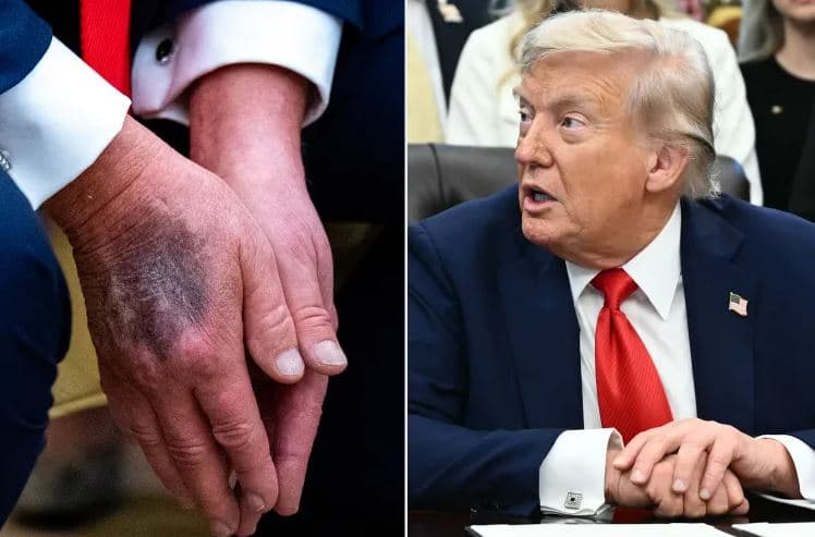 ترەمپ و دەستی لە نزیکەوە کە شین بووەتەوە. وێنە: Getty Images