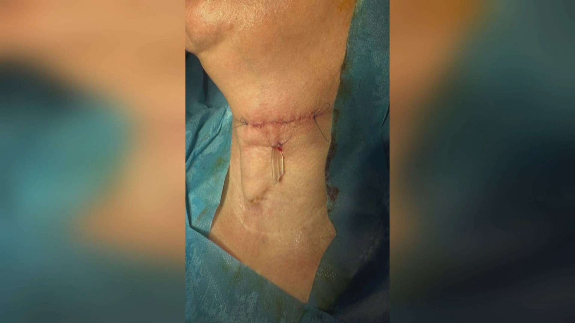 دوای پێنج ساڵ لە 'شەلەلی دەنگ' لە سلێمانی نەشتەرگەرییەکی دەگمەن بۆ نەخۆشێک کرا