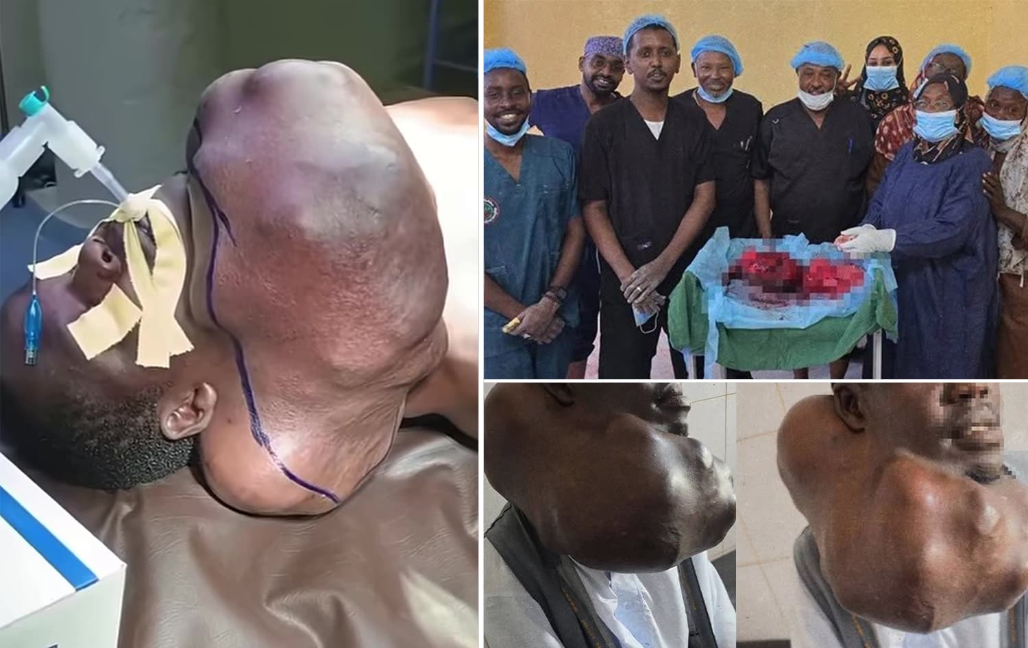 لە سوودان گرێیەکی 5.5 کیلۆگرامی لە رژێنی پەریزادەی پیاوێک دەردەهێندرێت
