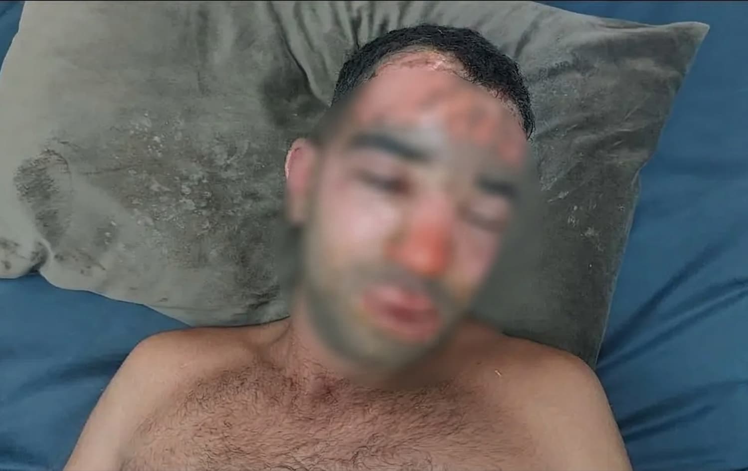 PAK: Di êrişê de fosfora spî hat bikaranîn û laşê 9 Pêşmergeyan şewitî