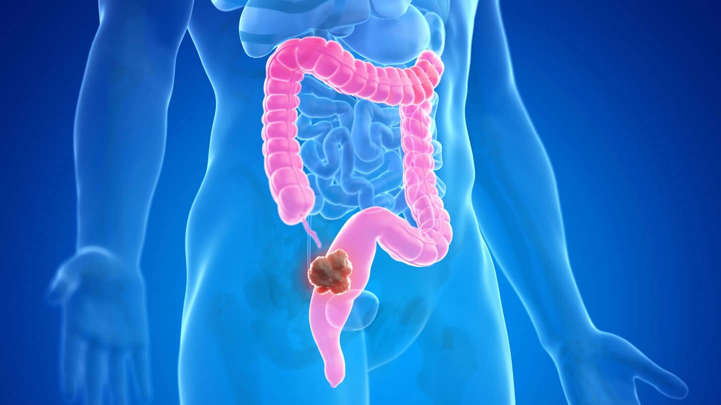 ئەکادیمیای ئەمریکیی منداڵان: شێرپەنجەی کۆڵۆن لە گەنجاندا لە هەڵکشاندایە