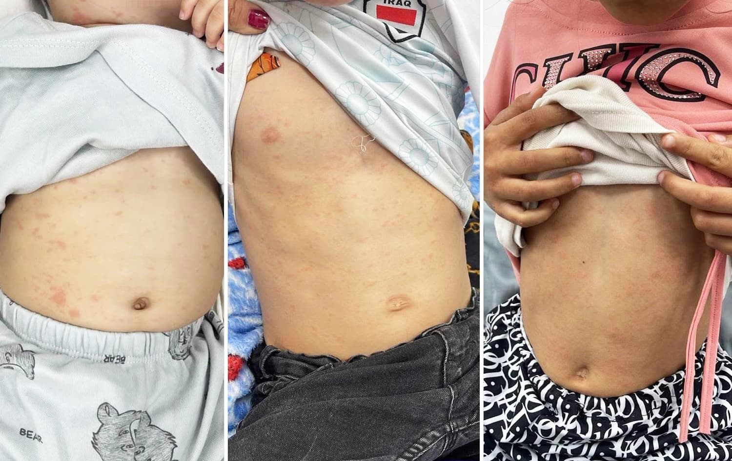 تەندروستیی دهۆک: تەنیا لە ئاکرێ 13 منداڵ تووشی سوورێژە بوون